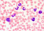 CBC (Complete Blood Count) แลบส์พื้นฐานที่ไม่ควรมองข้าม