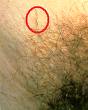 มารู้จัก โลน และญาติๆ ของมัน (โรค Pediculosis) กันดีกว่าครับ