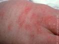 erythema toxicum neonatorum