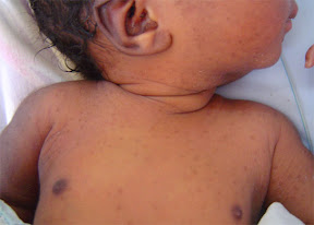 transient neonatal pustular melanosis