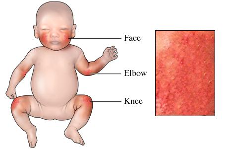atopic dermatitis