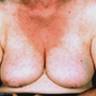 มารู้จัก…ผื่นแพ้แดด (Photodermatitis) กันครับ