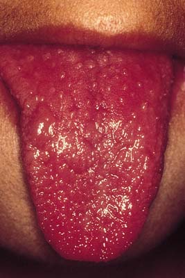 strawberry tongue