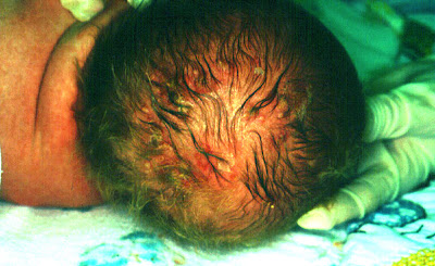Neonatal HSV