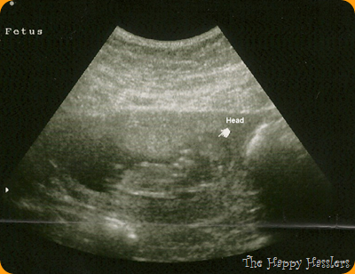 12 week ultrasound 2nd child