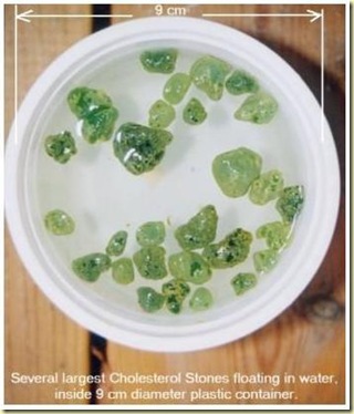 gallstones-chol-
