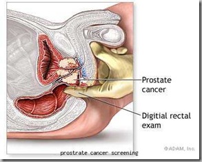 prostrate cancer screening prostrate cancer screening