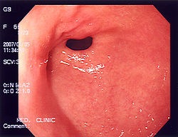 [250pxStomach_endoscopy_115.jpg]