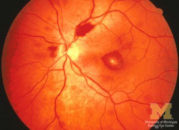 subacute bacterial endocarditis prophylaxis