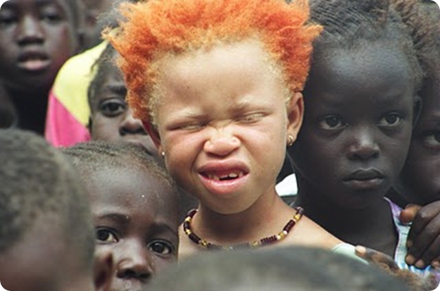 57. Niña albina (1)