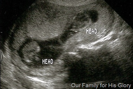[ultrasound of twins[7].jpg]