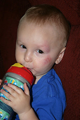 Spencer with Road rash