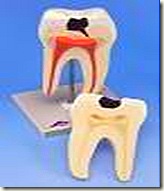 carie,denti,dentista,placca,rimedi placca,placca batterica,placca dentaria,cura denti,cura placca dentaria,rimuovere placca dentaria,rimuovere placca batterica