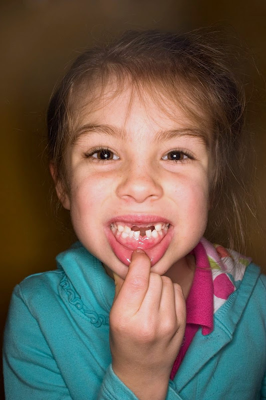 Sophia, Minus 4 Teeth