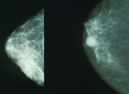 [Mammo_breast_cancer.jpg]