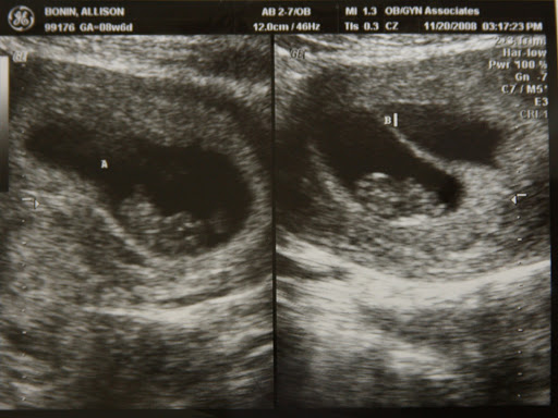 Ultrasound showing both babies