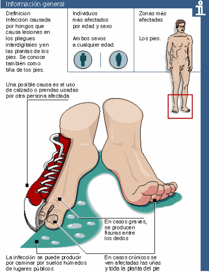 [Pie de Atleta, Grafico[3].gif]