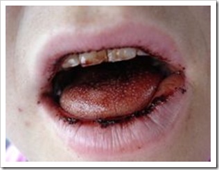 blood-mouth