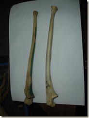 left (green markings) ulna has fusion on lower end(above 25 years), right has incomplete fusion at lower end (21-22 yrs),