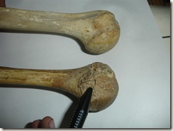 lower female humerus with incomplete fusion of head,21-22 years, upper humerus complete fusion, above 25 years
