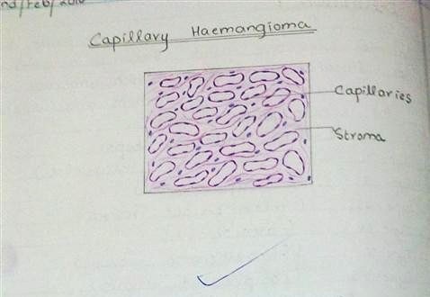 [capillary hemangioma H&E diagram[2].jpg]