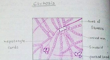 [cirrhosis diagram H&E[2].jpg]