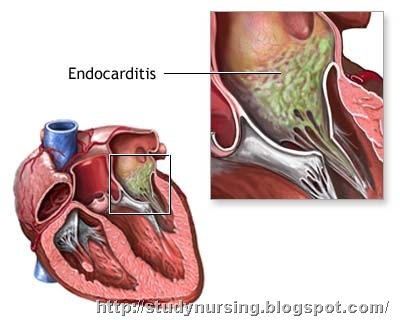 [endocarditis[1].jpg]
