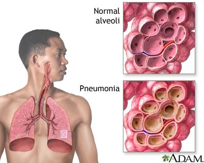 [pneumonia[5].jpg]