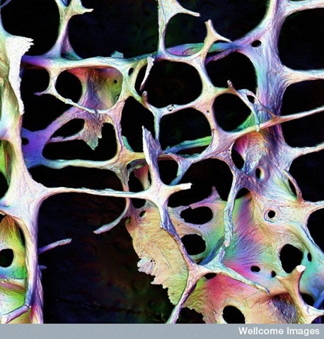 [osteoporosis[2].jpg]