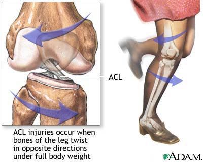 ACL5