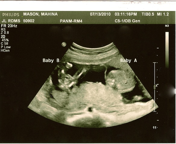 [Baby A Baby B 16 weeks edit[5].jpg]