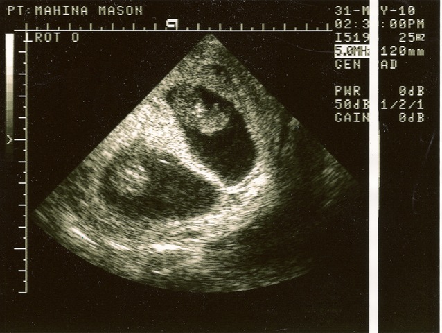 [twins 10 weeks[5].jpg]