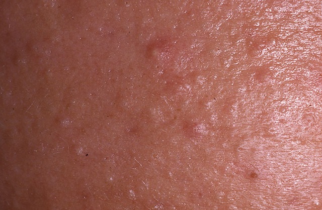 [acne-closed-comedo-14[3].jpg]