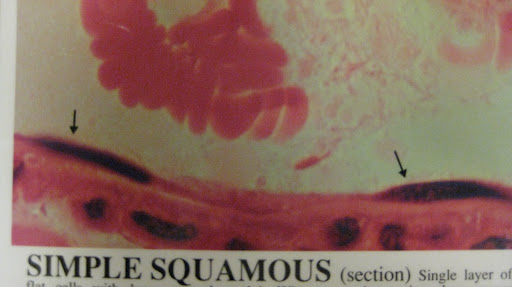 squamous