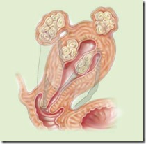 uterine_fibroids uterine_fibroids
