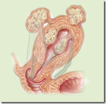 uterine_fibroids