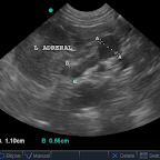 Left Adrenal Nodule in a dog
