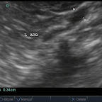 Left Adrenal Atrophy, Same Dog