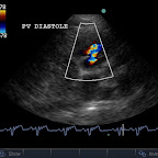 Valvular Pulmonic Stenosis in a 6mo Terrier cross