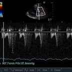 Continuous Wave Doppler Trace - Same Cat