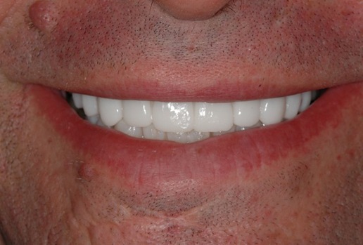 teeth2