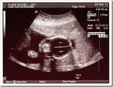 Ultrasound Pic - Top View