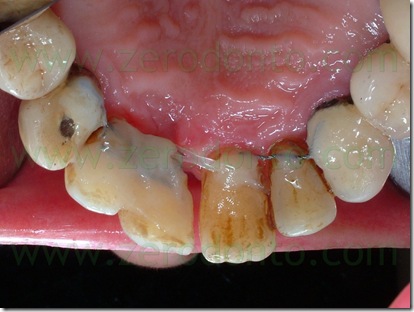 retainer ortodontico