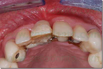 retainer occlusale