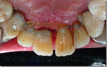retainer attivo