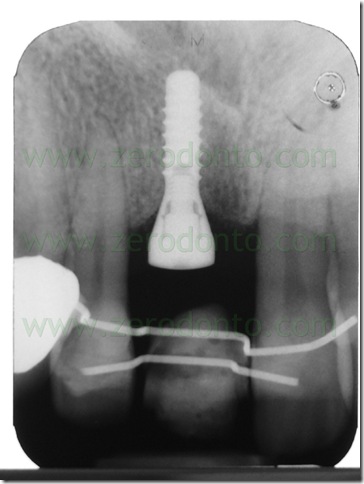 radiografia impianto