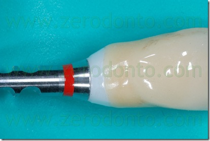 analogo impianto zirconia