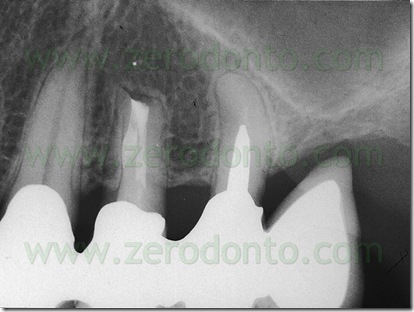 endodonzia mta endodonzia mta