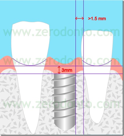 Posizionamento impianti zona estetica Posizionamento impianti zona estetica