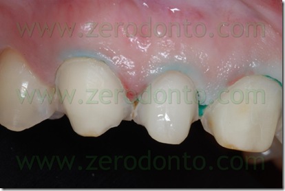 preparazione a chamfer con overlap palatale